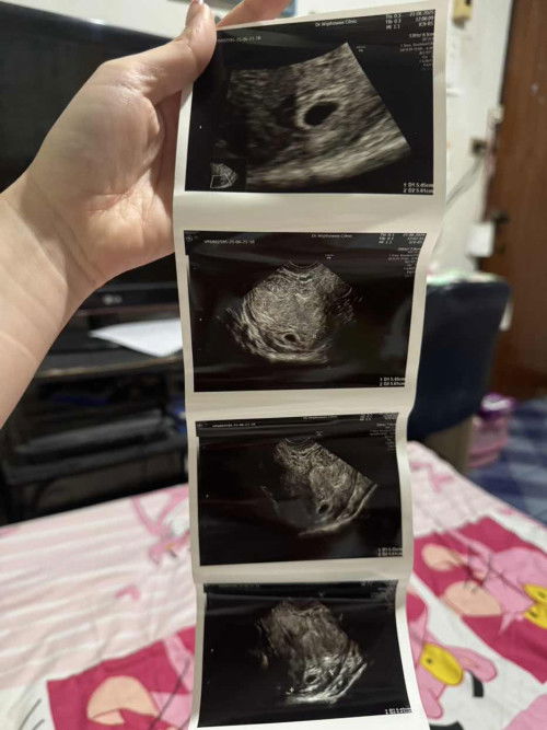 ป้าหมอบอกว่าแม่เป็นมดลูกรูปหัวใจ
