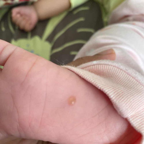 Kaki bentol berisi air