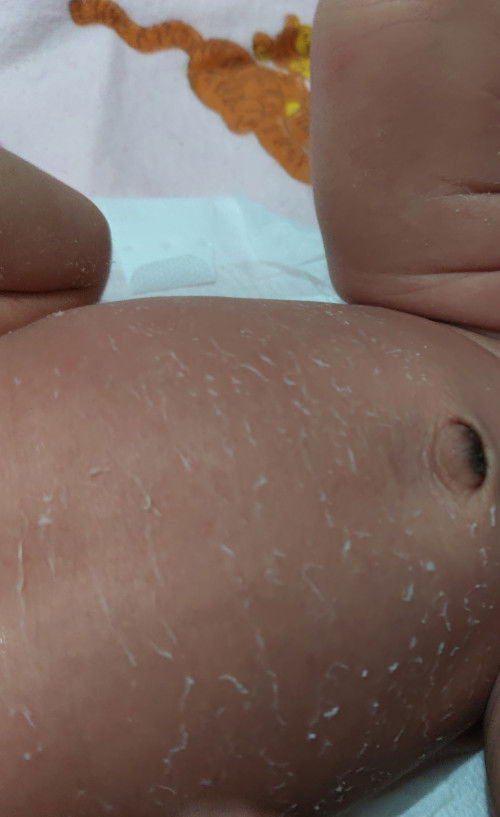 Bayi kulit nya kering