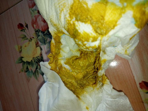 สีอึแบบนี้ปกติไหมคะ