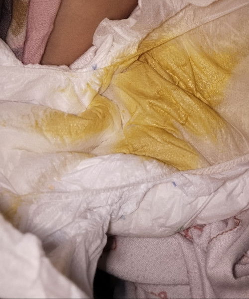 Ini diare bukan bun?
Umur bayi 2bln mix asi dan sufor
Klo iya cara ngatasin nya gmnnyaa bun?