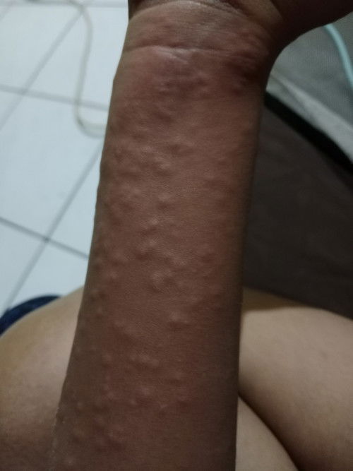 Tangan anak saya kaya gini udah beberapa hari,awalnya cuma sedikit sekarang jadi banyak