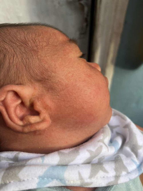 Baby Acne on newborn