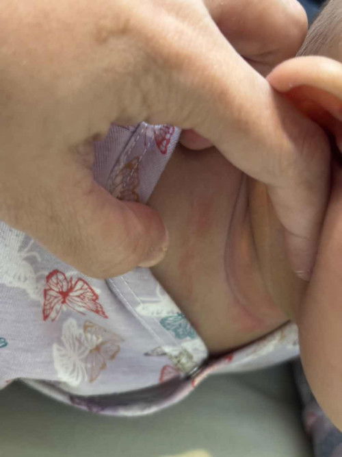 Leher kemerahan pada bayi usia 4,5 bulan