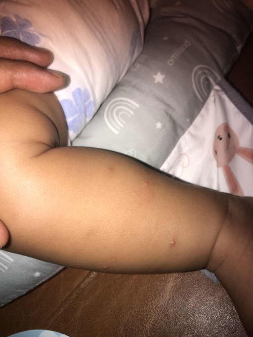 Bintik pada kulit bayi