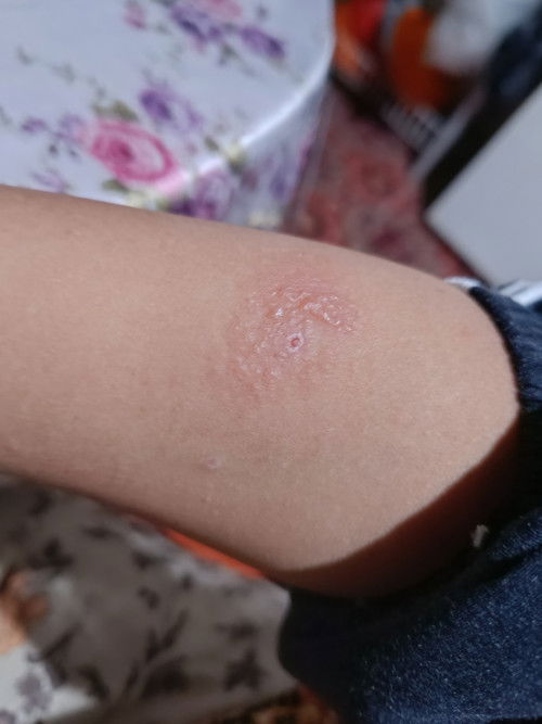 Habis kena cacar