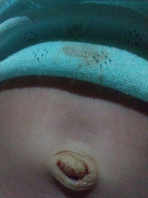 pusar belum kering granuloma umbilikalis