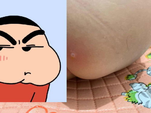 Benjolan pada bayi