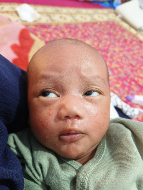 Bayi bruntusan