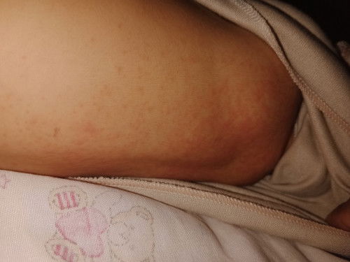 Kemerahan Bayi Usia 2 Minggu