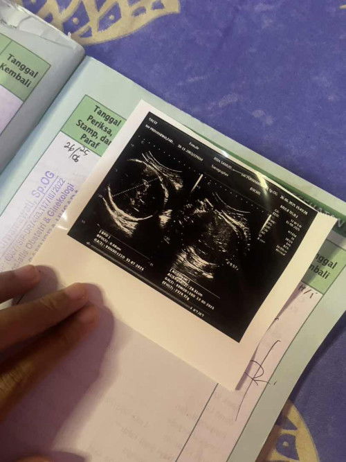 33 weeks BBJ 2.3 Kg