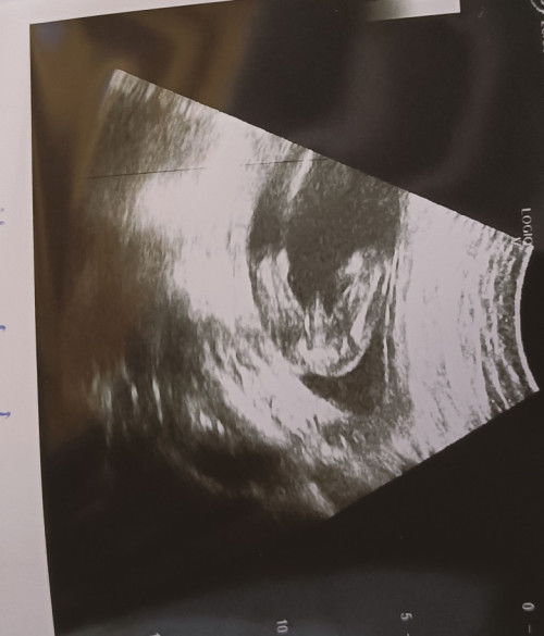 Doctor kata ni boy, ada x kemungkinan girl? 😂 scan 18 minggu