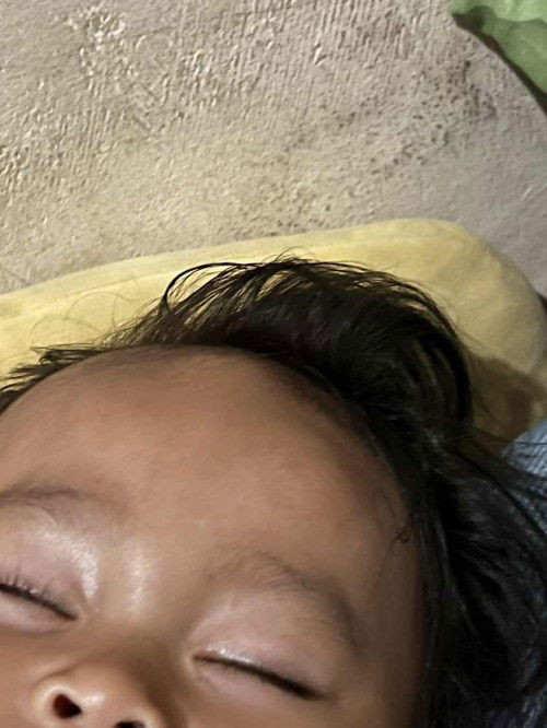 Kepala bayi dekat ubun" menonj