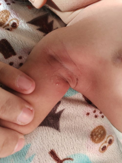 Jerawat Pada Bayi