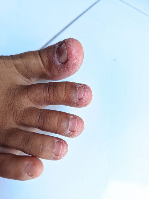 Kaki kering pecah2 mengelupas
