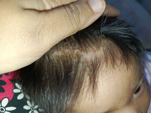 Kulit kepala berkuping