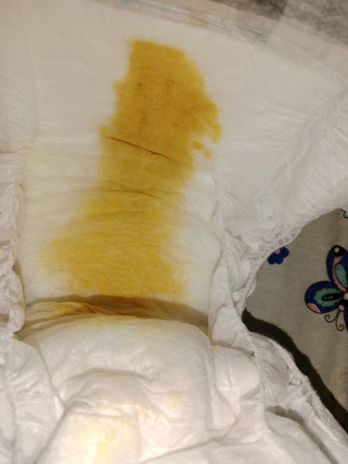 Bayi satu bulan bab nya bisa lebih dri 3x dan punya kaya gini normal ga yh bu ibu full asi
