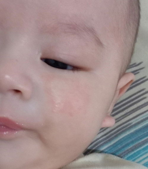ruam pipi bayi