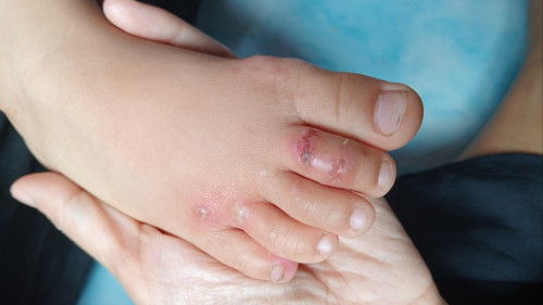 Gatal dan luka pada anak 3 tahun