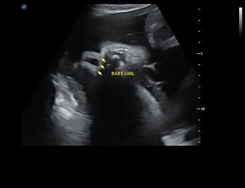 gender baby