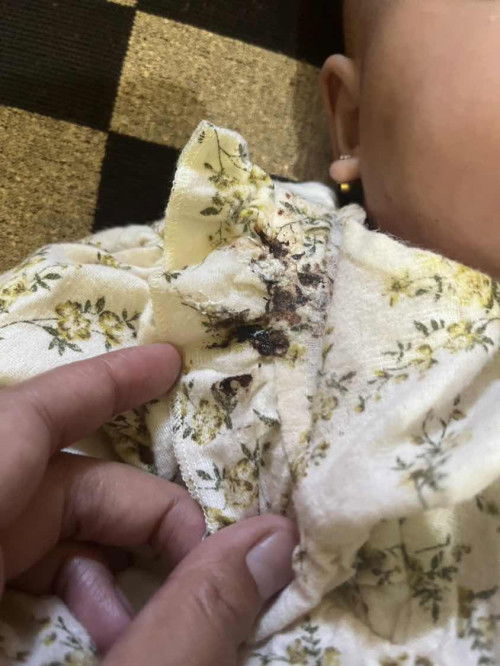 Gumoh darah serelah menyusu pasa puting lecet