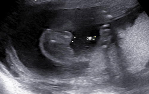 gender scan 19weeks