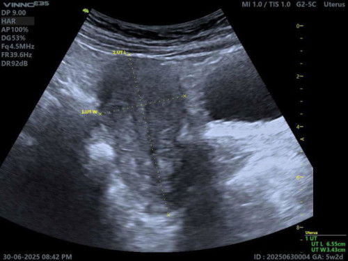 Miscarriage 5 weeks (Chemical Pregnancy)