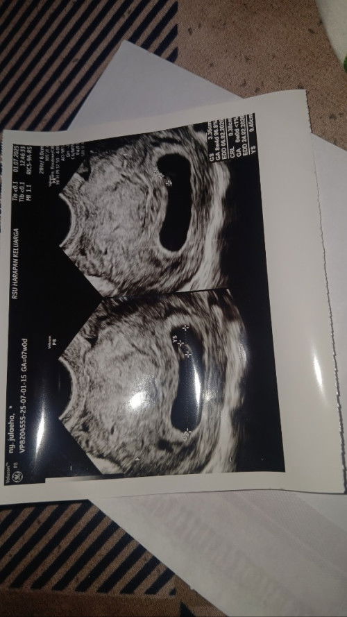 USG transvaginal