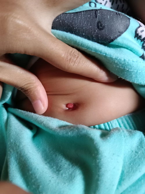 Granuloma umbikalis benjolan merah di pusar bayi