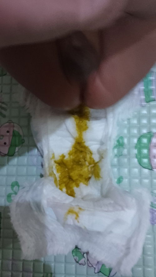 Pup agak cair sudah 2 hari, hari ini dah 5x pup normal ga ya,. Apa susunya ga cocok ganti dancow