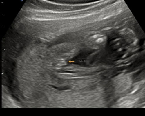 Gender 20w