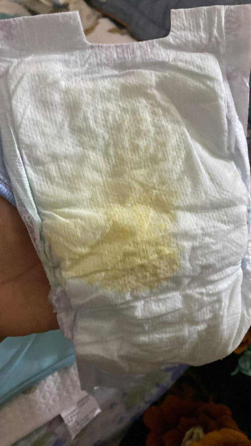 Đi ngoài phân lỏng
