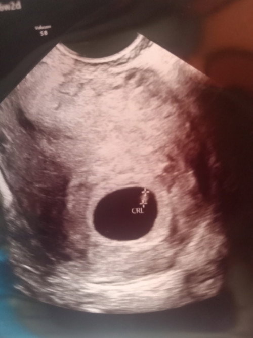 Hamil 6w3d tapi belum terlihat janinnya