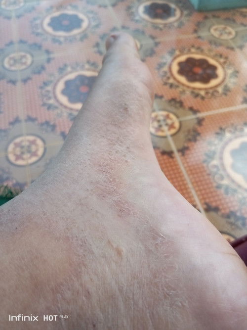Mau tanya dong aku lagi hamil
Kaki aku kya gini ini kenapa ya bawaan hamilkh atu apa?