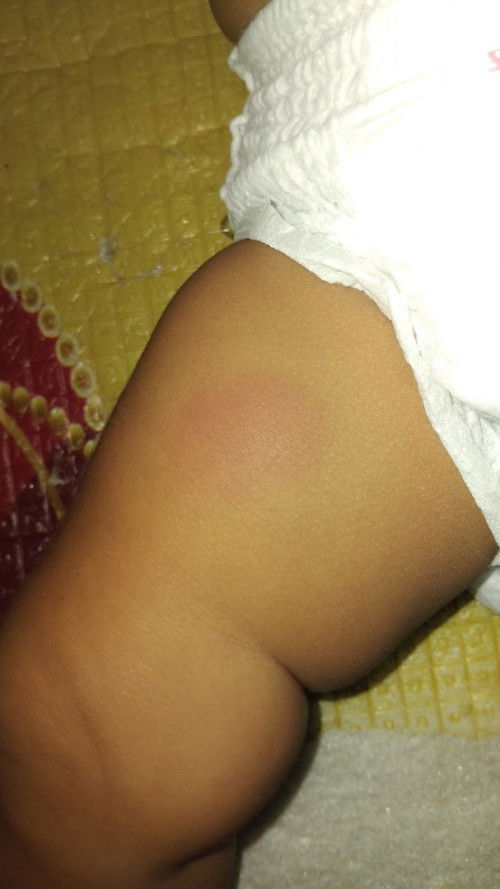 ลูกแพ้หรือโดนอะไรกัดคะ