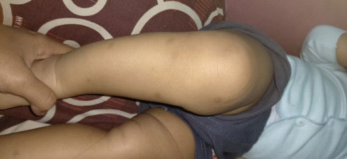 Krim ampuh penghilang bekas gigitan nyamuk