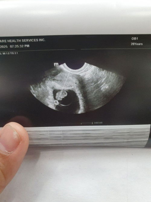 Irregular mens with PCOS.
#Miraclebaby❤️