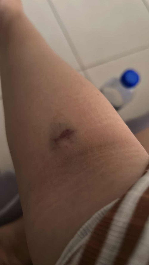 Tangan bengkak lepas amik darah