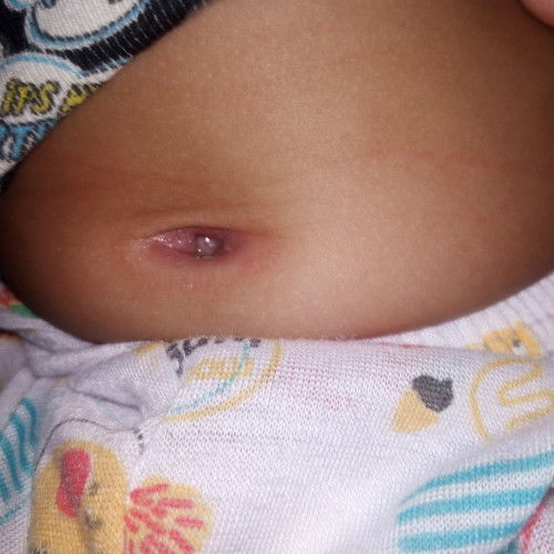 Granuloma pada bayi 2 bulan