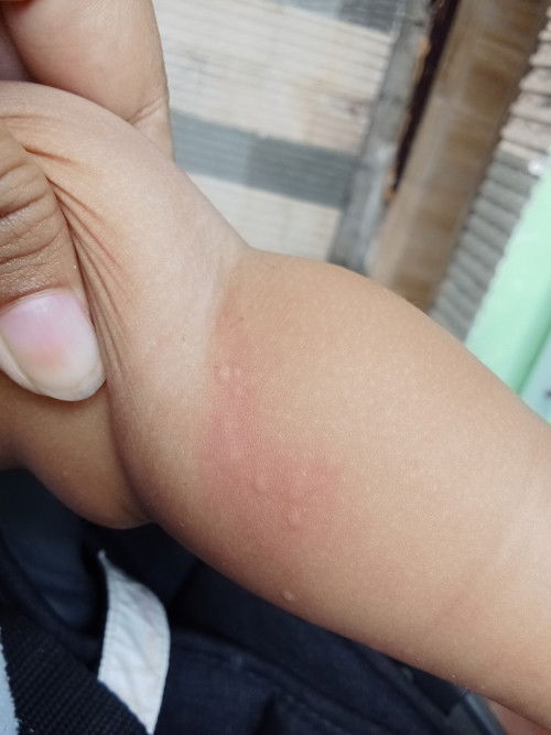 Badan bentol merah merah