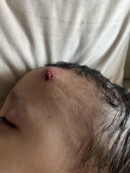 bisul selalu tumbuh kat anak
