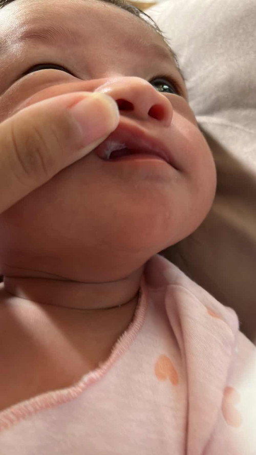 Jamur di mulut bayi