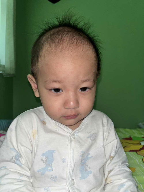 ลูกมีผื่นแดงหลังจากเป็นไข้