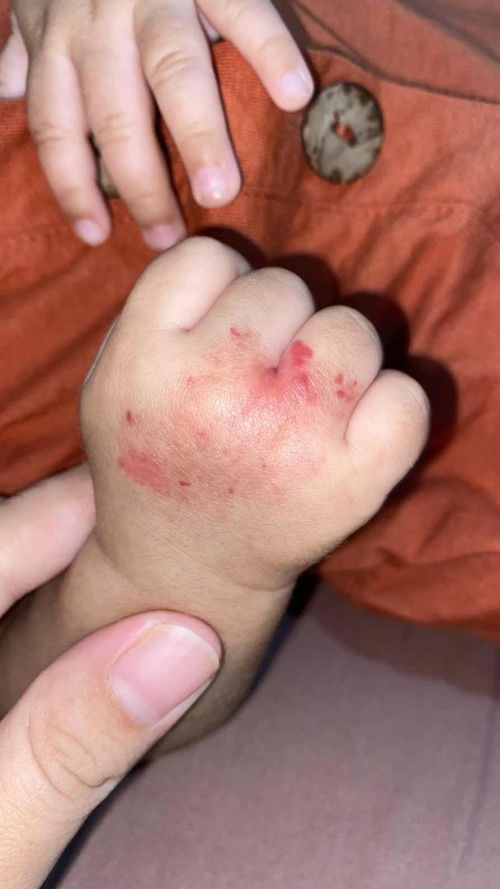kulit bayi sensitif