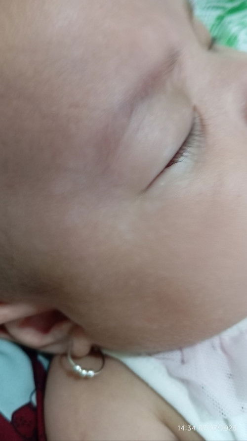 Cho e hỏi có bé nào bị nổi trắng trắng trên mặt giống con e ko ạ,e đi khám thì bác sĩ nói là k sao