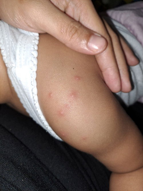 Bentol² pada kulit anak 1th