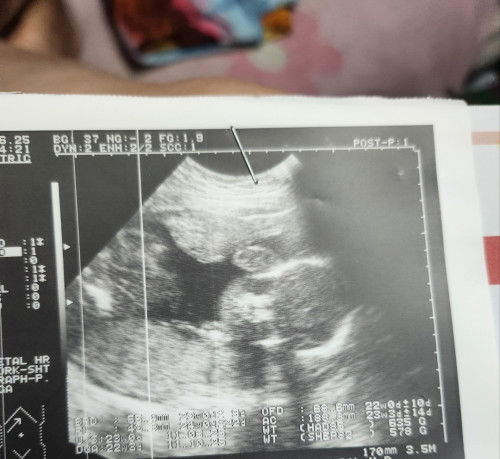 Mga mi 24 weeks ultrasound ko sabi ng ob ko girl daw kaso diko alam tong pic kung ano ba psisyon ni