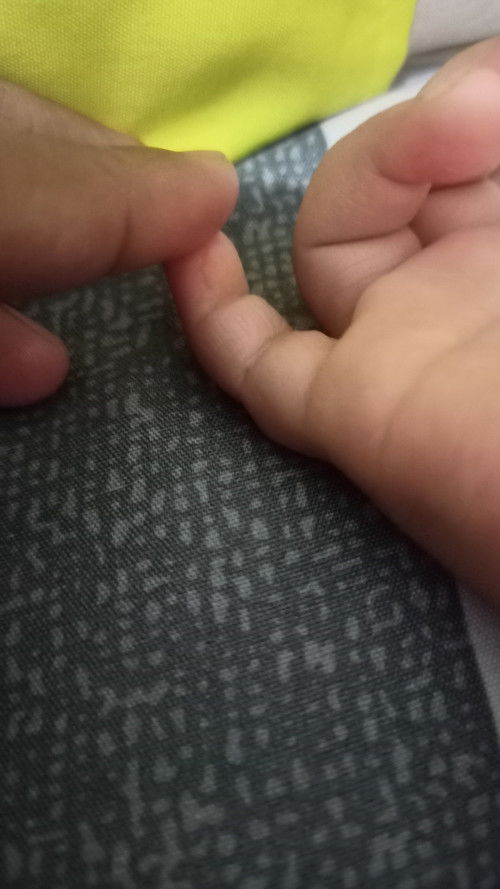 Anak udah lama jari nya kenak ini, saya gak tahu ini penyakit apa ya bunda tolong bantu jawab ya bun