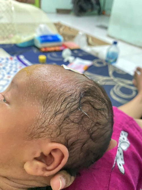 Beruntusan pada bayi