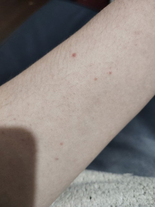 During Pregnancy,do you also have this kind of skin red spots ?
